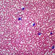 Infectious mono