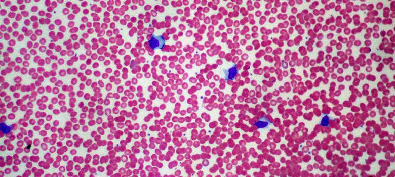 Infectious mono